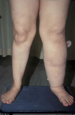 Venous Leg Swelling 