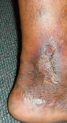 Venous Leg Ulcers