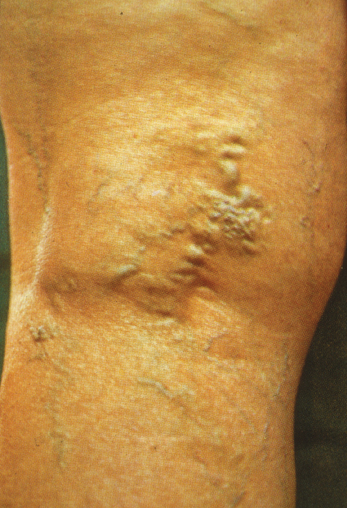 Reticular Veins