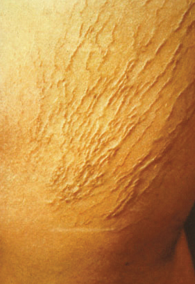 Varicose Veins