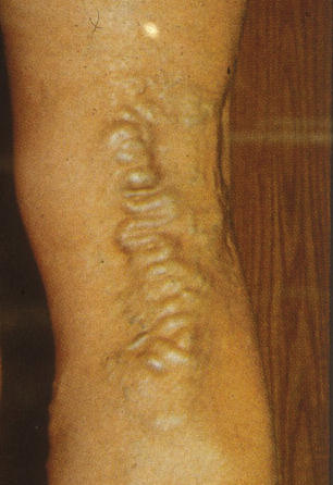 Varicose veins